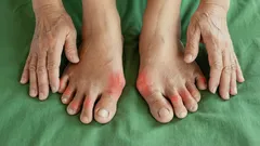 Vaivaako varpaiden nivelkipu jatkuvasti? Asiantuntijat kertovat, miten pääset siitä eroon lopullisesti